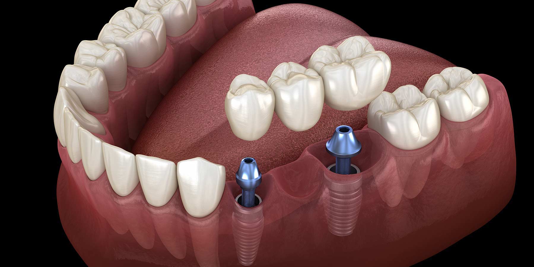 Протезирование зубов инвалидам 3 группы. Стоматология импланты. Дентальный имплантат. Имплантация мостовидный протез.