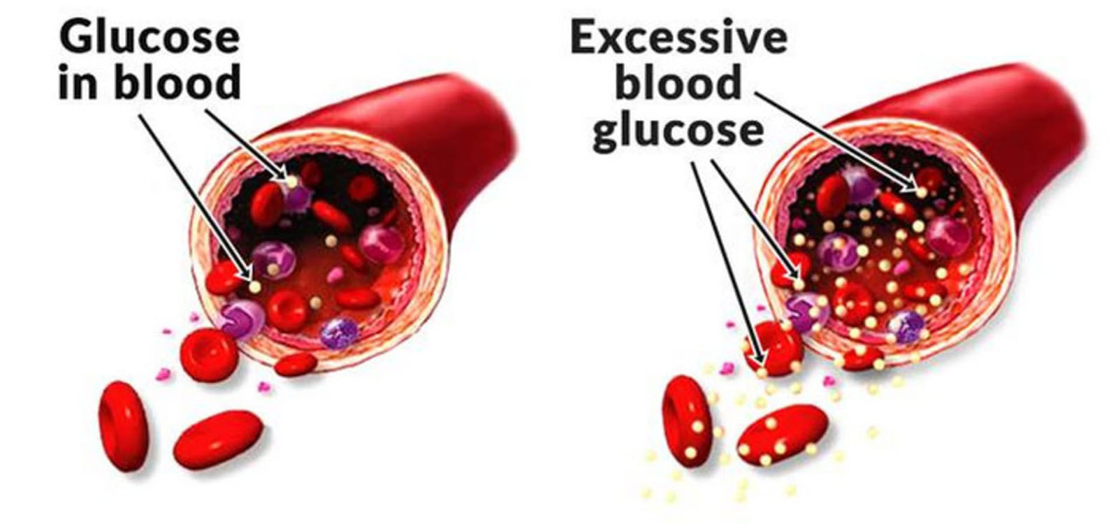 Большое количество глюкозы в крови