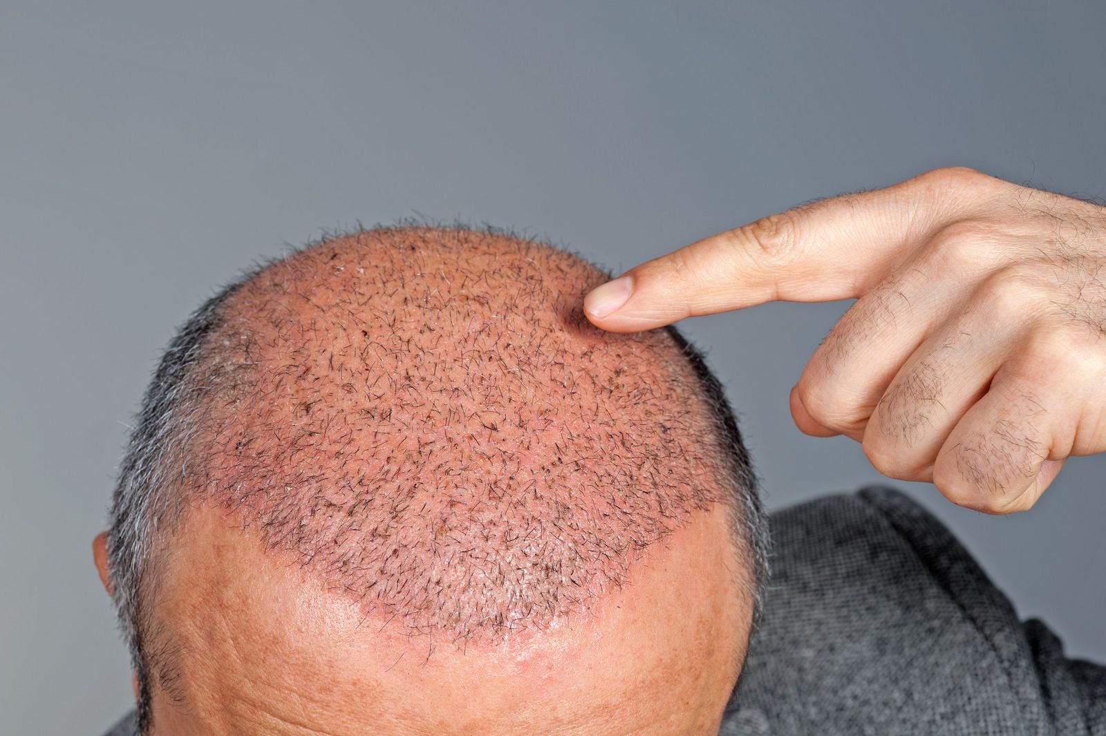 Top 7 Hair Transplant Clinics in Istanbul (in 2019) by  afroamericanhairtransplant - Issuu