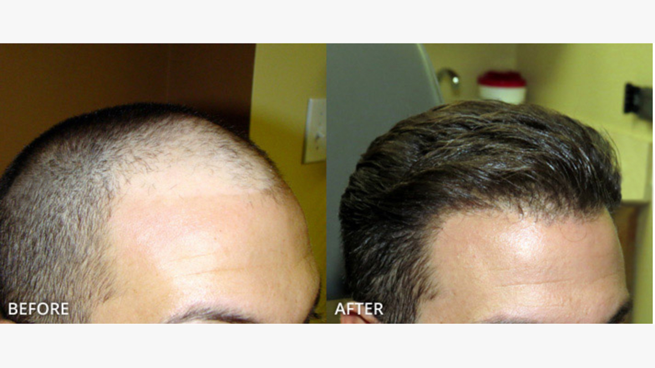 Smile Hair Clinic Implements a Cutting-Edge Sapphire Hair Transplantation  Method