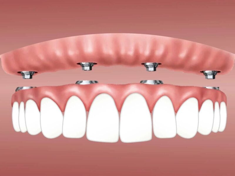 Dental implants are a perfect solution for anyone who's missing a single tooth or a whole mouthful. Get all the information you need about implants today.