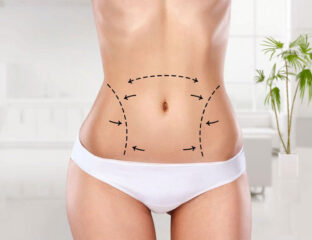 Many people believe liposuction is an excellent way to lose large amounts of fat. Here's everything you need to know.