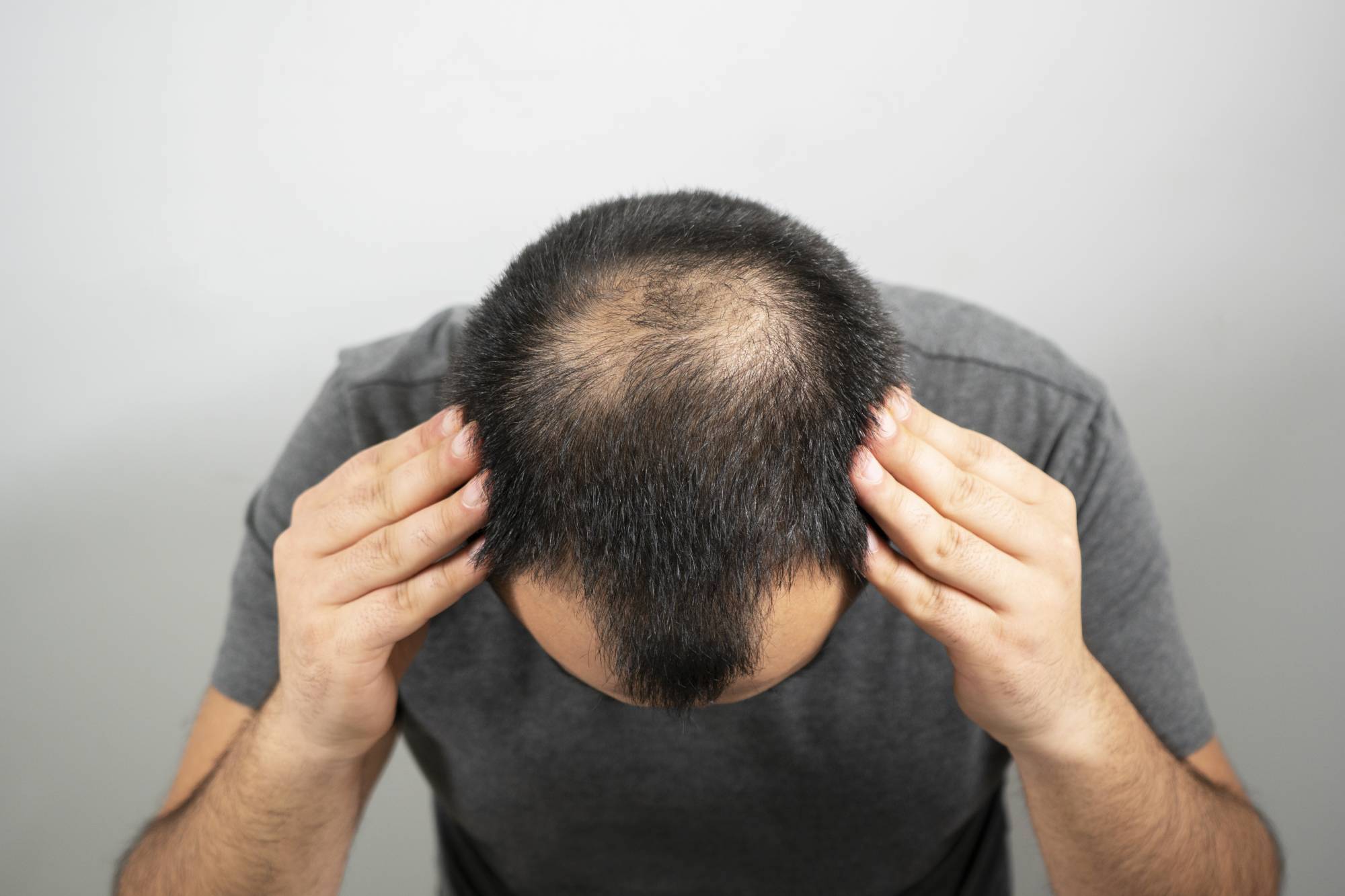 One of the major issues that men and women face nowadays is hair loss. Which vitamins could help restore your hair?