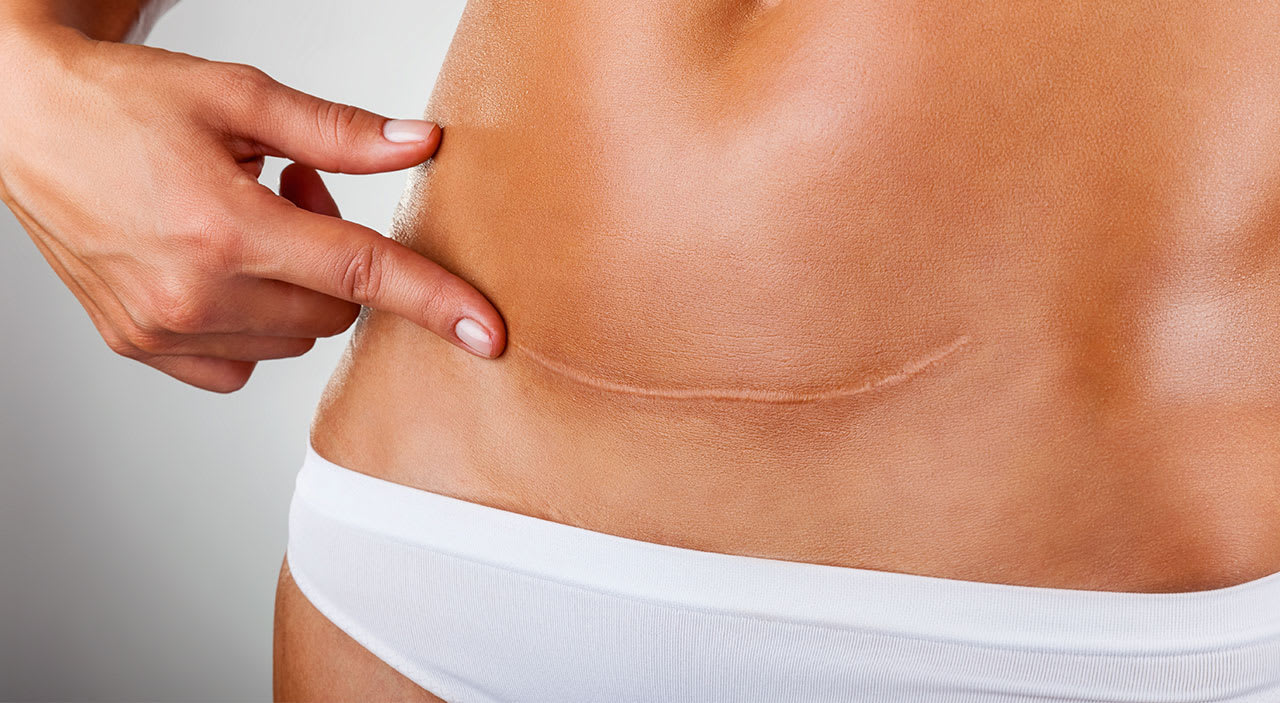 Women undergo a complete body change after giving birth to their babies! Is a tummy tuck or liposuction the best? Let's find out.