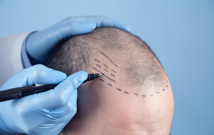 Hair thinning or hair loss can affect your self-esteem and confidence. Is Medart the best clinic in Turkey for hair transplants?