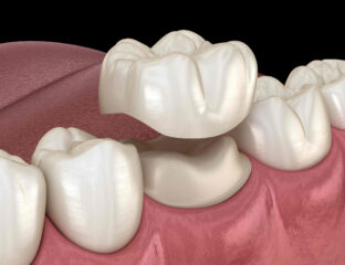 Zirconia crowns have quickly become the most popular choice of dental work. Here's why more and more people are making it their main form of tooth care!