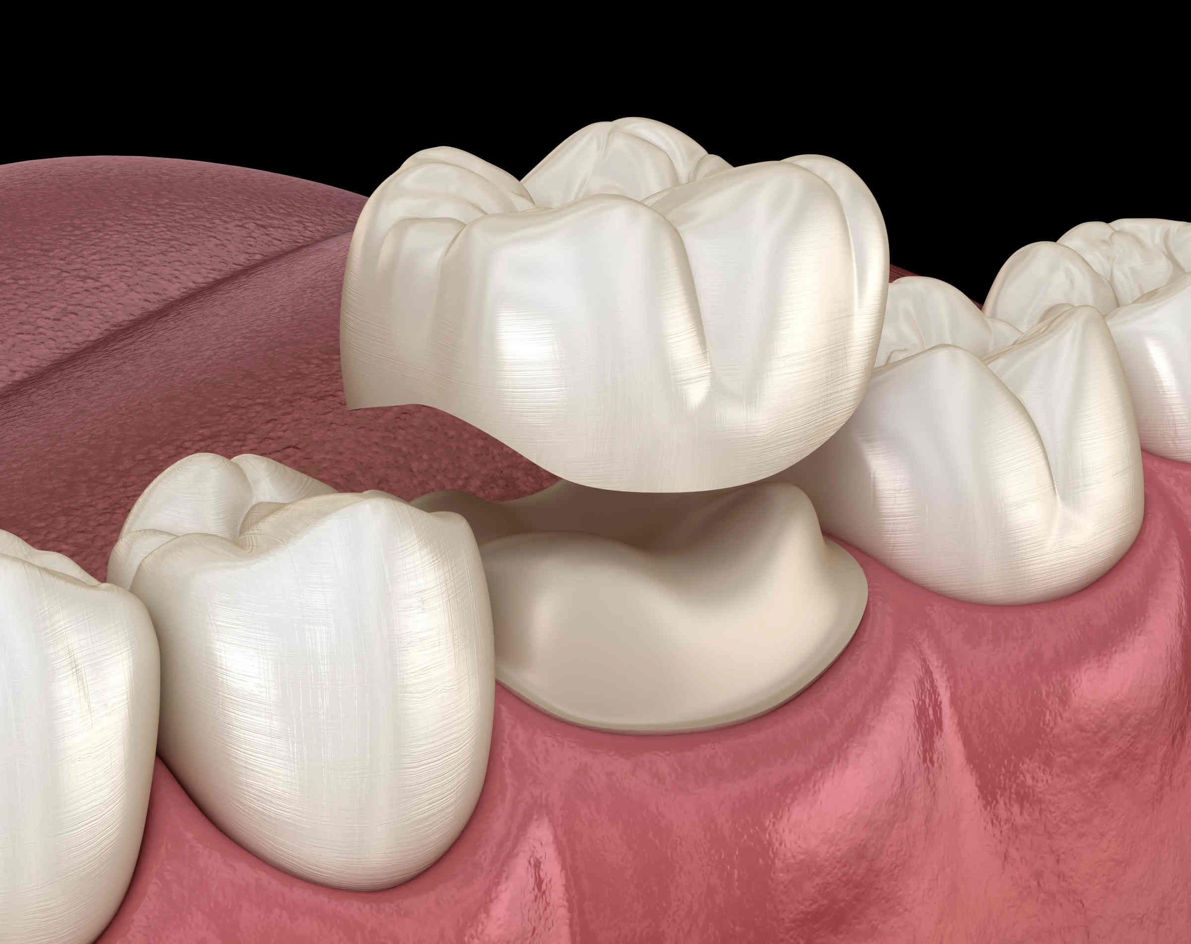 Zirconia crowns have quickly become the most popular choice of dental work. Here's why more and more people are making it their main form of tooth care!