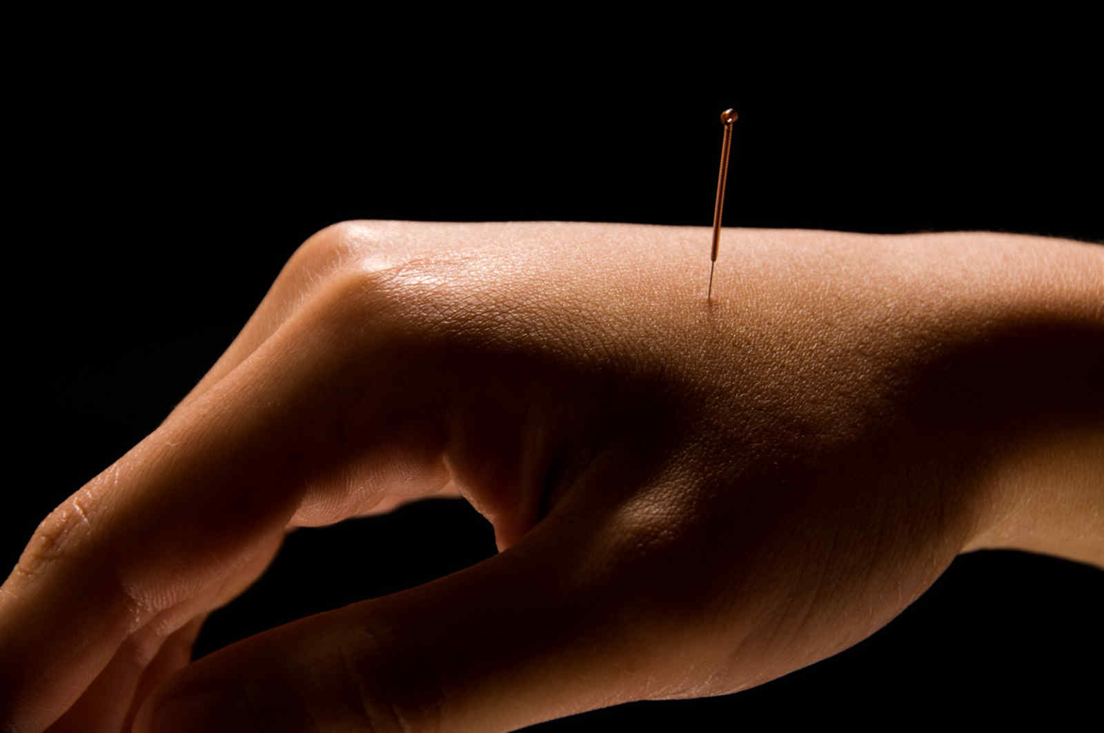 what is acupuncture