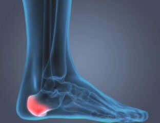 Heel spurs are most often treated with a combination of rest, ice, and over-the-counter pain relievers.