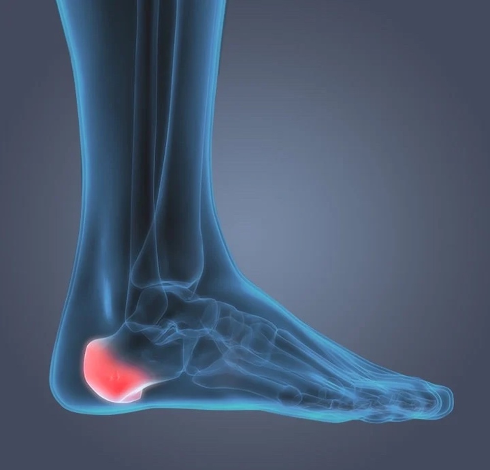 Heel spurs are most often treated with a combination of rest, ice, and over-the-counter pain relievers.