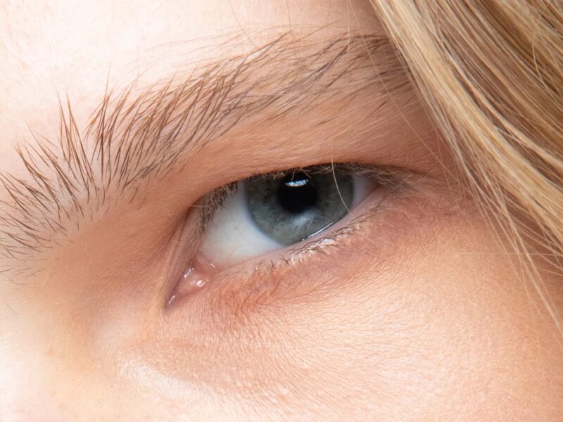 From simple home remedies to topical treatments and surgery, there are many options available. Here's how to treat under eye bags.