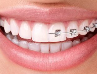 Invisalign Over Traditional Braces