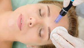 Microneedling Leicester