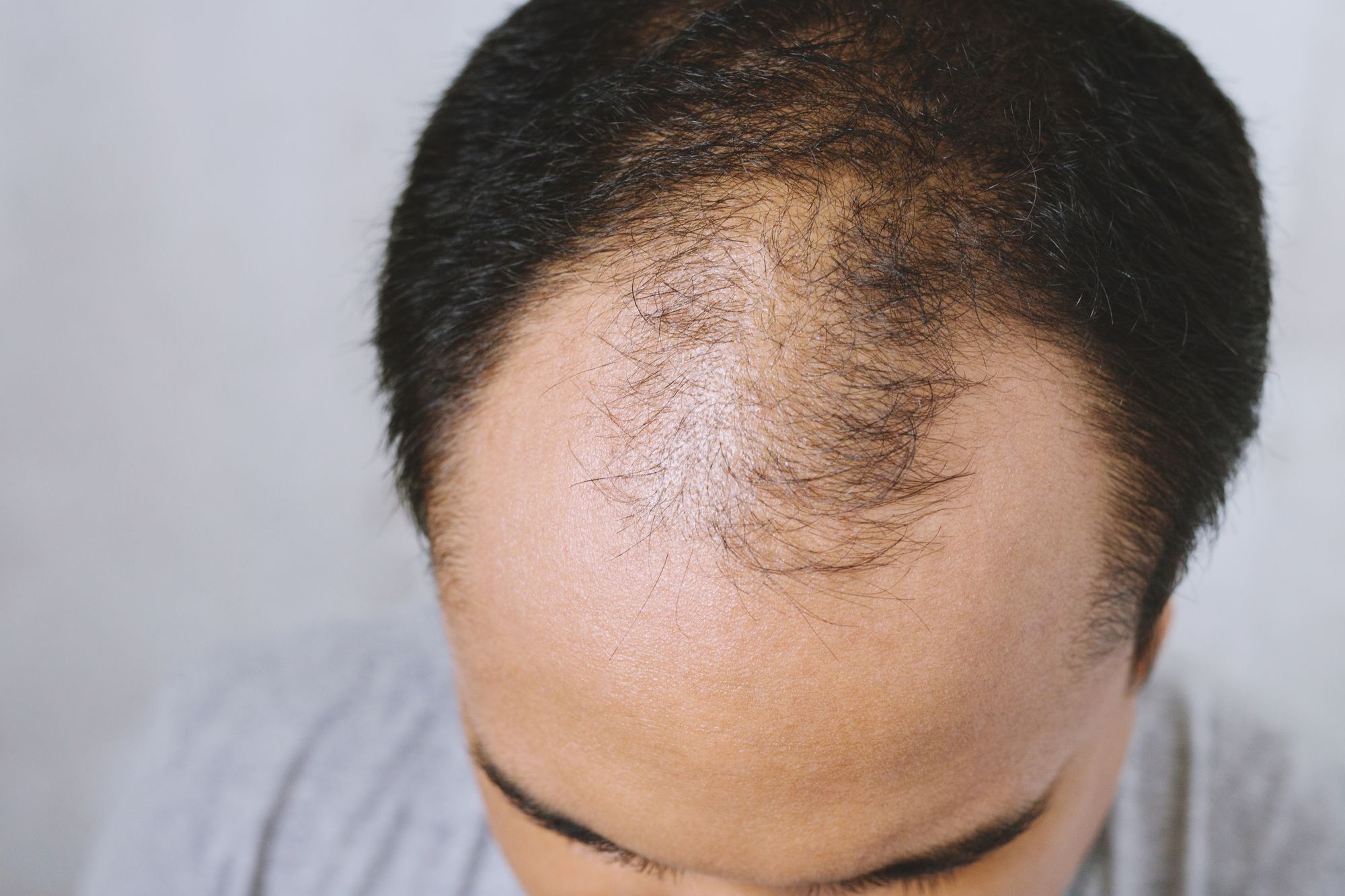 Understanding Medications That Can Lead to Hair Loss
