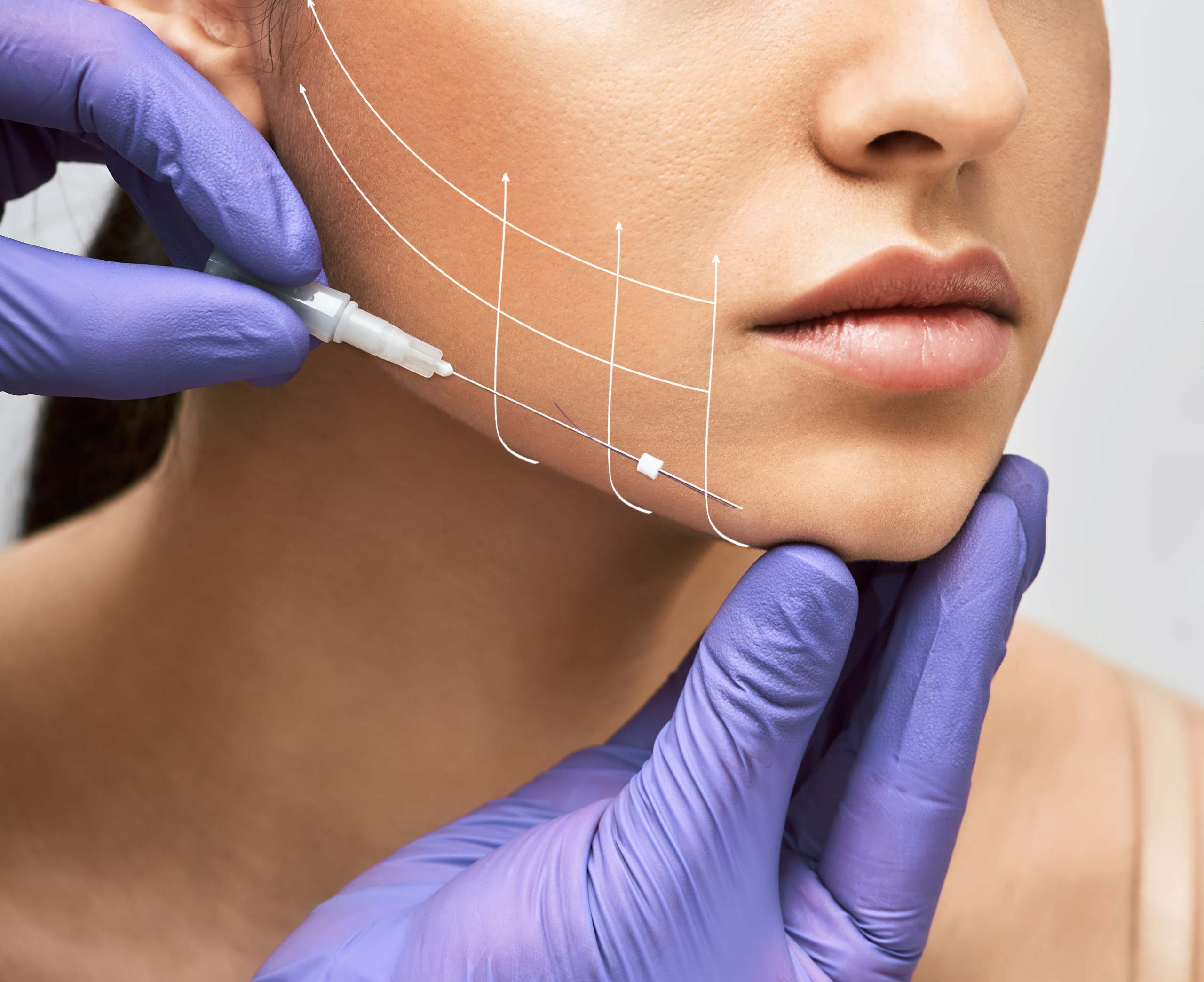 Anti-Wrinkle Injections in Sydney