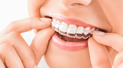 Magic of Invisalign