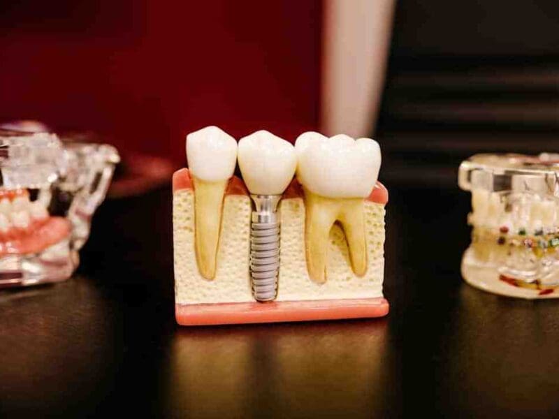 Transform your grin with tooth implants in Manassas, VA! Discover how All-on-4 dental implants can give you the smile you've always wanted—effortlessly!